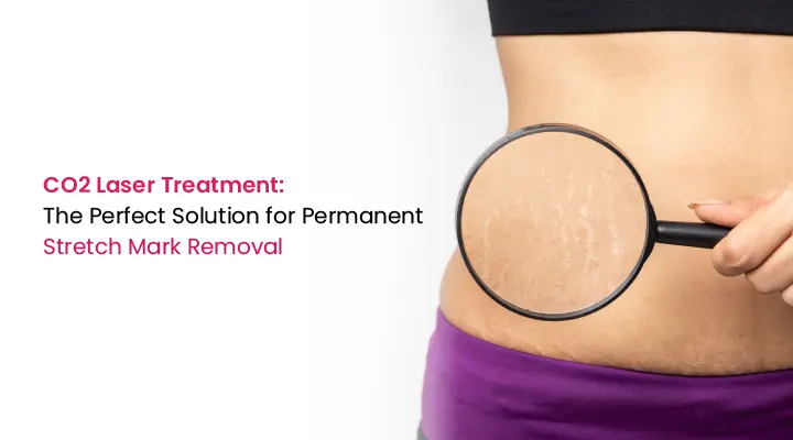 CO2 Laser Treatment: The Perfect Solution for Permanent Stretch Mark Removal