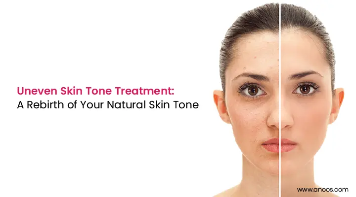 Uneven Skin Tone Treatment: A Rebirth of Your Natural Skin Tone